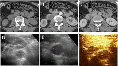 Multimodal imaging features of retroperitoneal anastomosing hemangioma: a case report and literature review